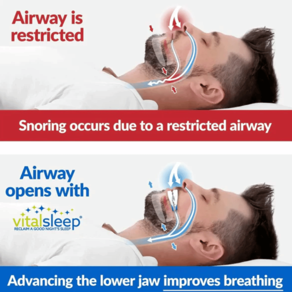 Vital Sleep Anti-Snoring Device